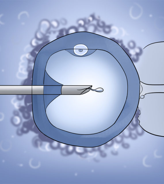 Intracytoplasmic Sperm Injection (ICSI Treatment)