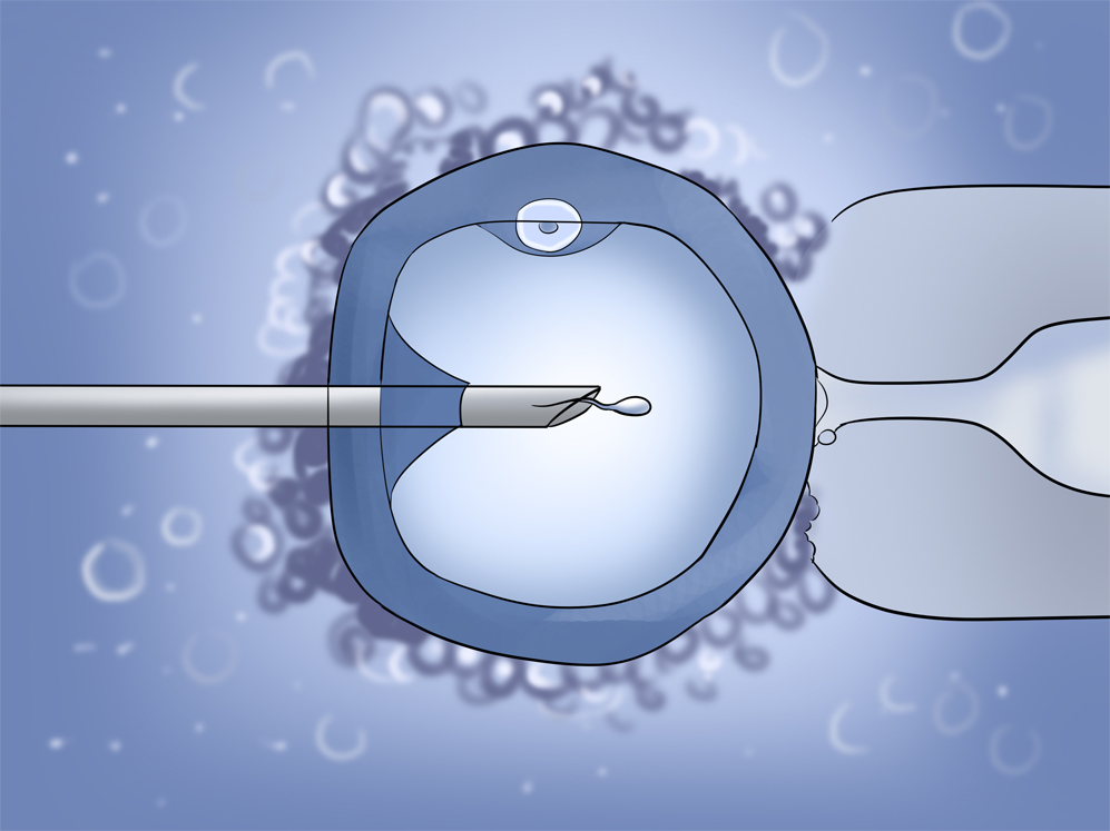 Intracytoplasmic Sperm Injection (ICSI Treatment)
